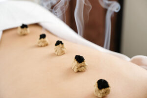 Acupuncture and moxibustion on the back of a woman in a bright acupuncture center