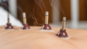Moxibustion traditional Chinese medicine technique with burning mugwort moxa stick placed on meridian points on woman's back.