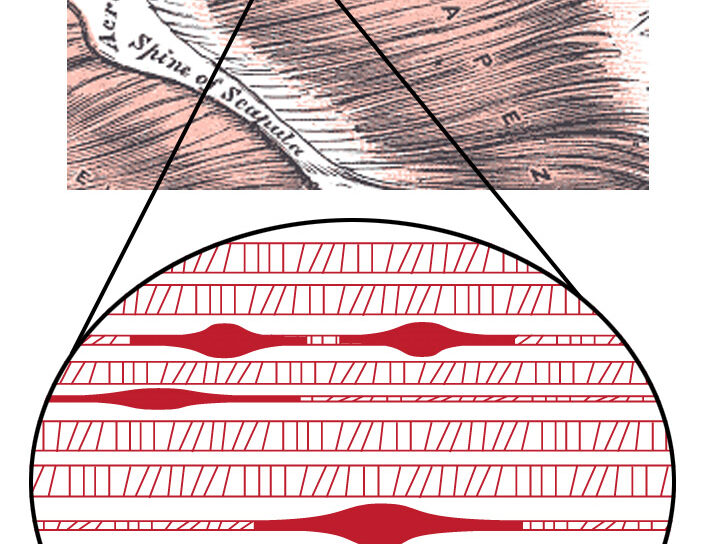 Trigger_Point_Complex