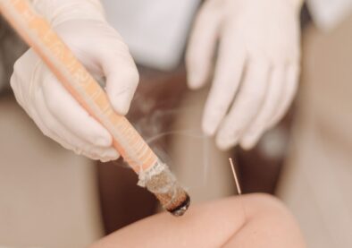 Close-up of an acupuncture treatment with moxibustion, showcasing therapeutic technique.