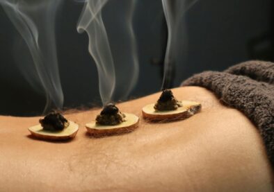 Close-up of traditional moxibustion therapy with smoke rising from moxa cones.